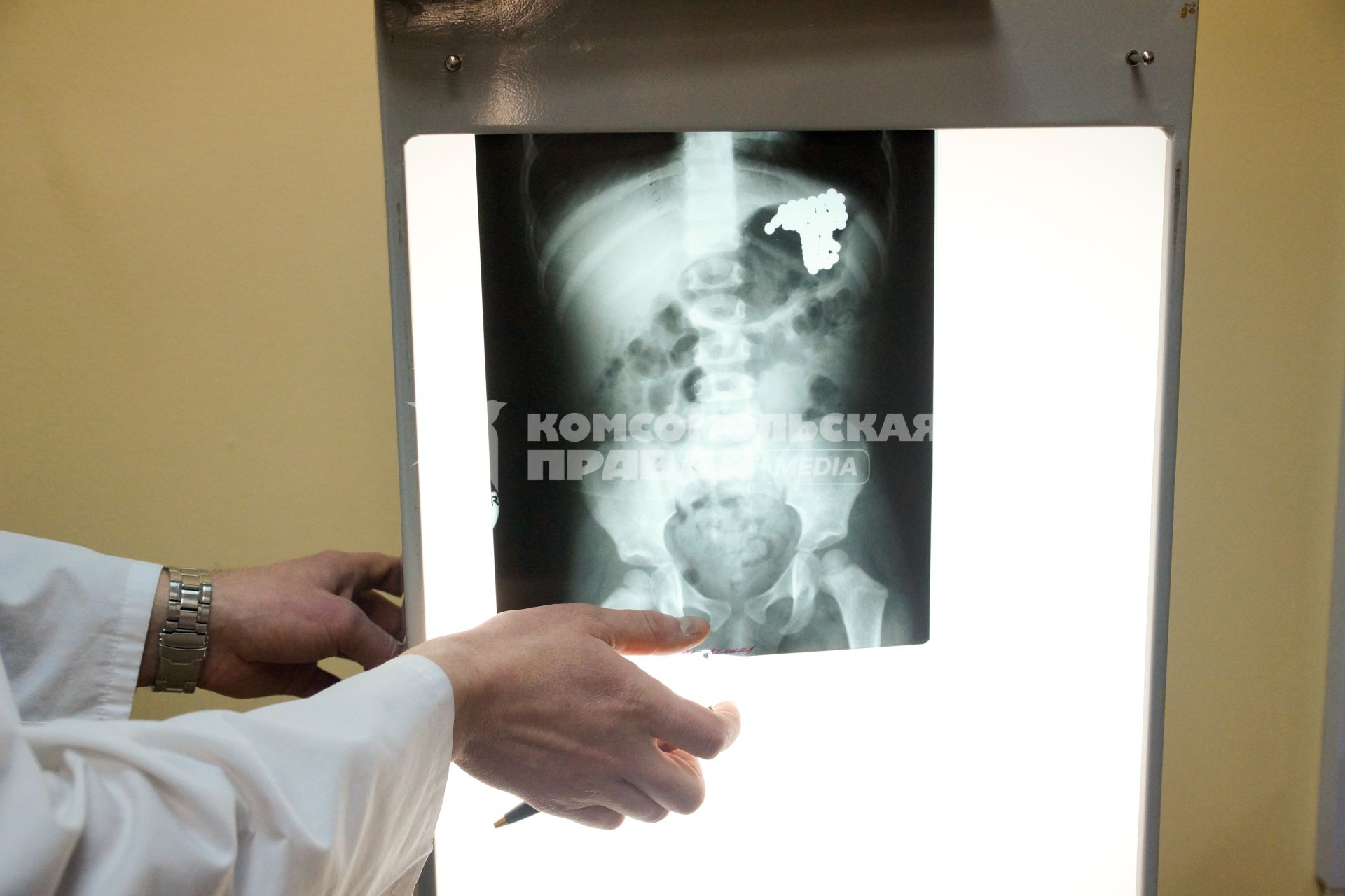 Врач показывает рентгеновский снимок ребенка, проглотившего магнитные шарики. Их извлекли в ходе хирургической операции. Детская многопрофильная больница №9 в Екатеринбурге