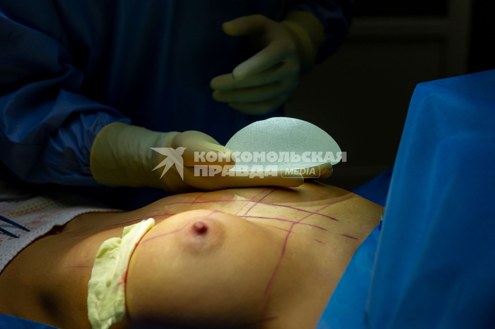 Санкт-Петербург. Операция по пластике груди в клинике имени Н.И. Пирогова.