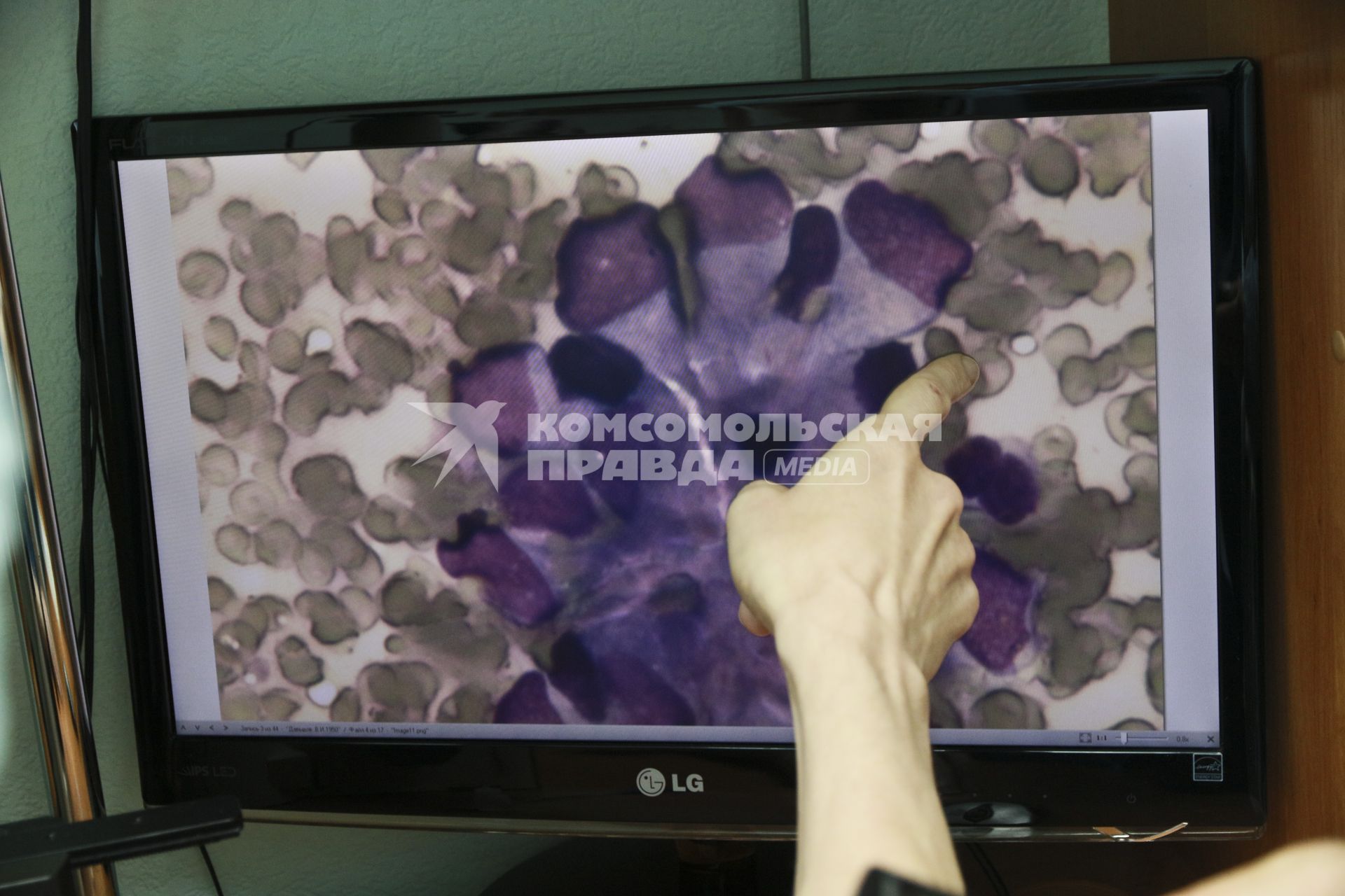 Барнаул. Раковые клетки на мониторе в онкоцентре.